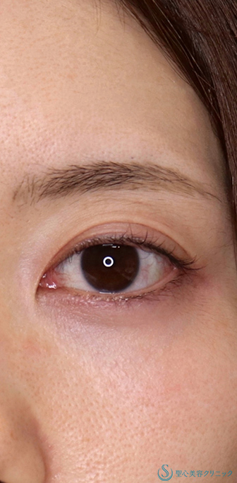 目上切開・修正_Before