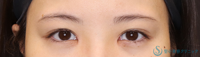 目頭切開＋目上切開_After