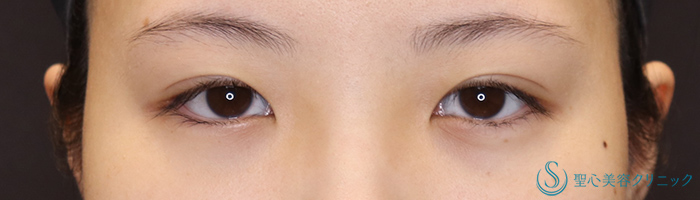 目頭切開＋目上切開_Before