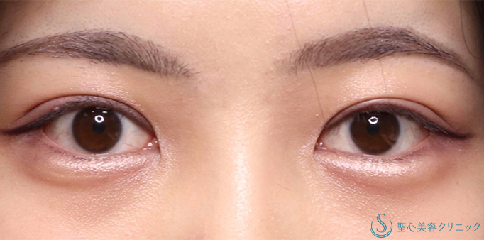 二重術（全切開）＋脱脂_After