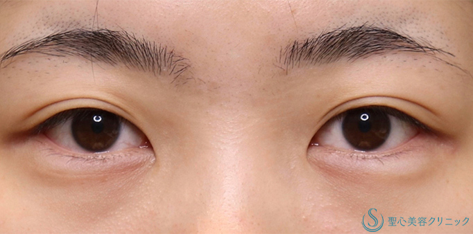 二重術（全切開）＋脱脂_Before