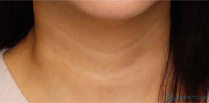 プレミアムPRP皮膚再生療法_Before