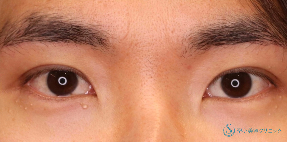 眉下切開法（眉下リフト）＋マイクロメソッド+α（3点固定）_After