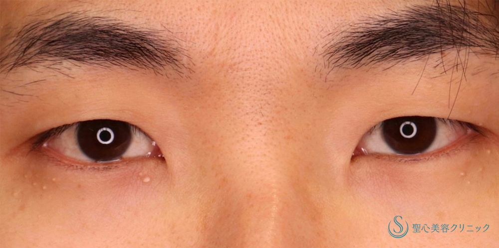 眉下切開法（眉下リフト）＋マイクロメソッド+α（3点固定）_Before