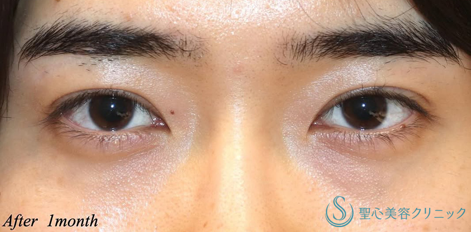 マイクロメソッド+α（二重埋没法）_After