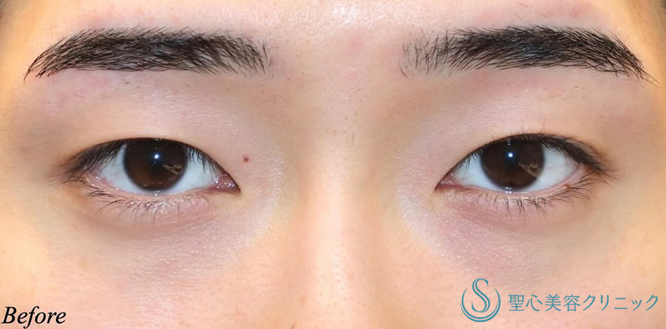 マイクロメソッド+α（二重埋没法）_Before