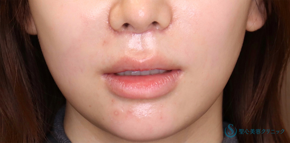 プレミアムリップリフト（プレミアム人中短縮術）_After
