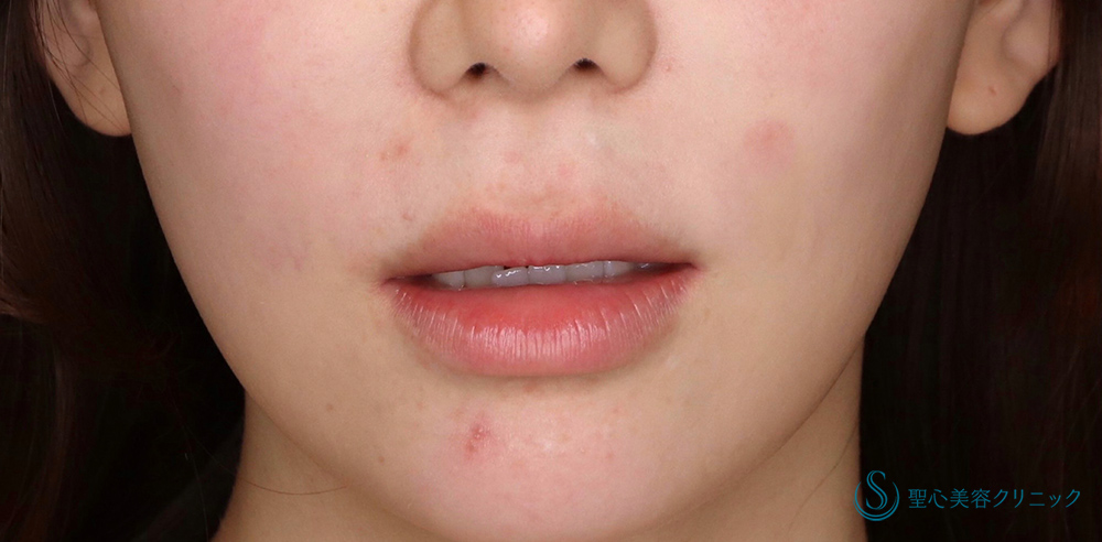 プレミアムリップリフト（プレミアム人中短縮術）_Before