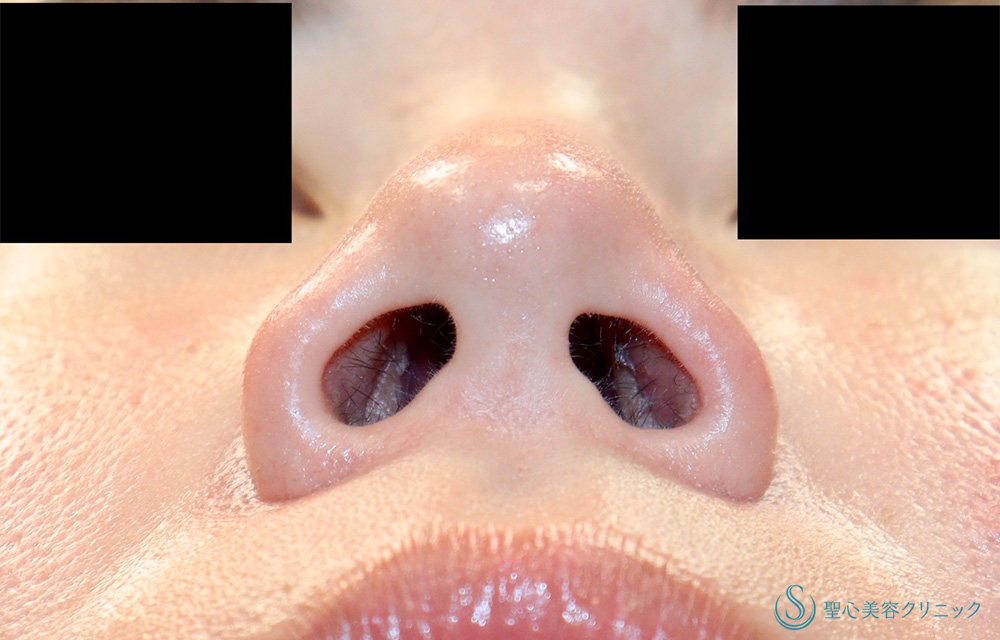 小鼻縮小_Before