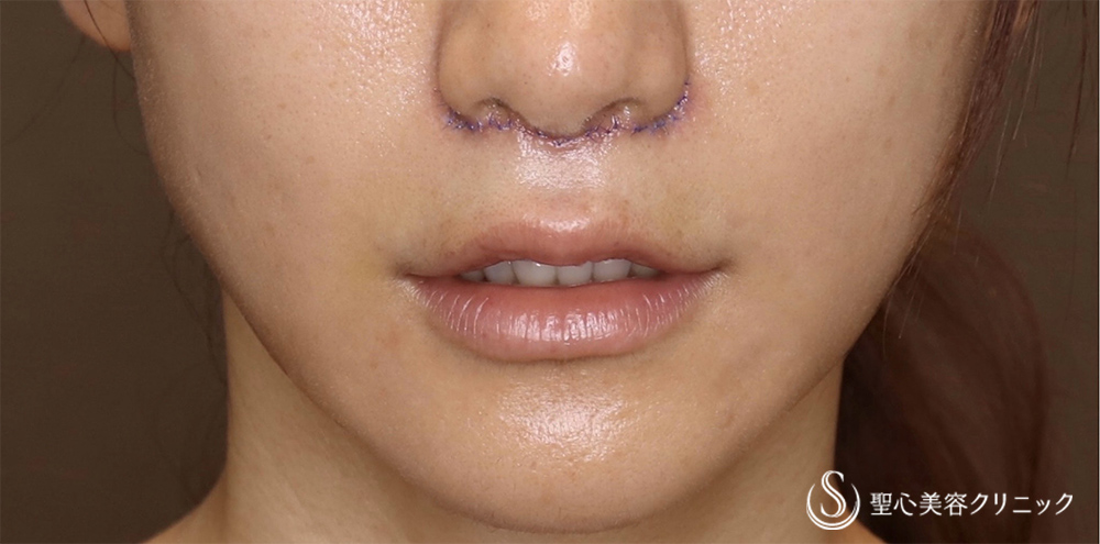 プレミアムリップリフト（プレミアム人中短縮術）_Before