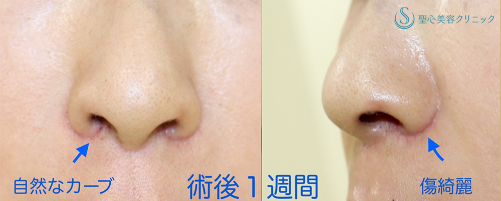 鼻孔縁下降術＋小鼻縮小_After
