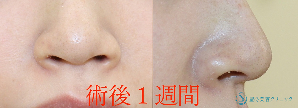 鼻孔縁下降術_After