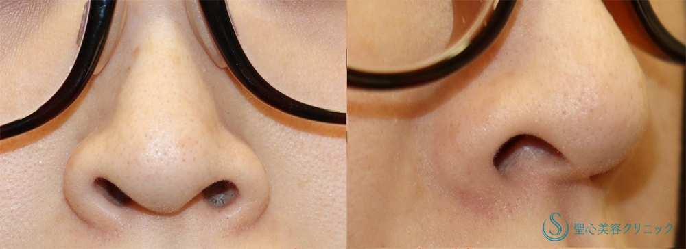 鼻孔縁下降術_Before