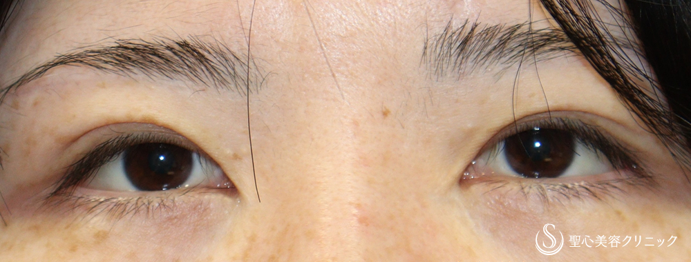 目上切開_Before